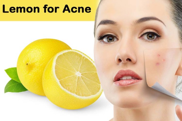 Acne Scars – Causes, Prevention Measures and Home Remedies, Indian Beauty Blog, skincare blog