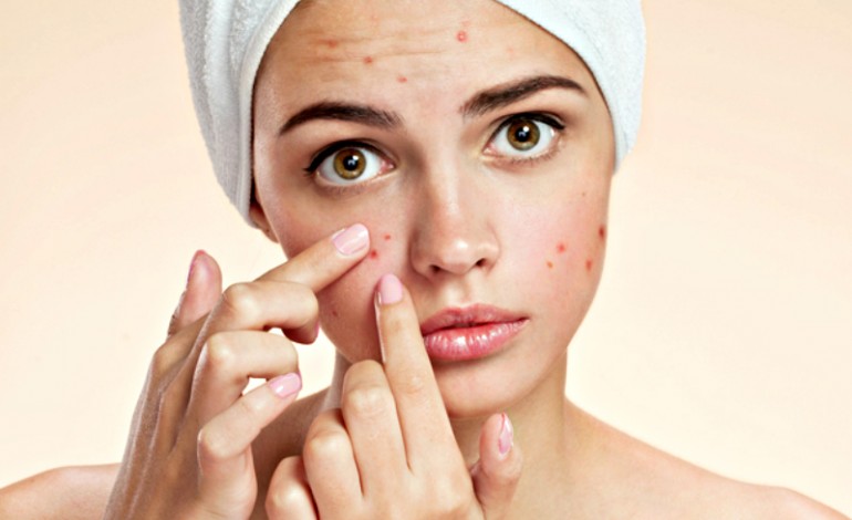 Stubborn acne? Avoid these 5 foods! Results in a month!