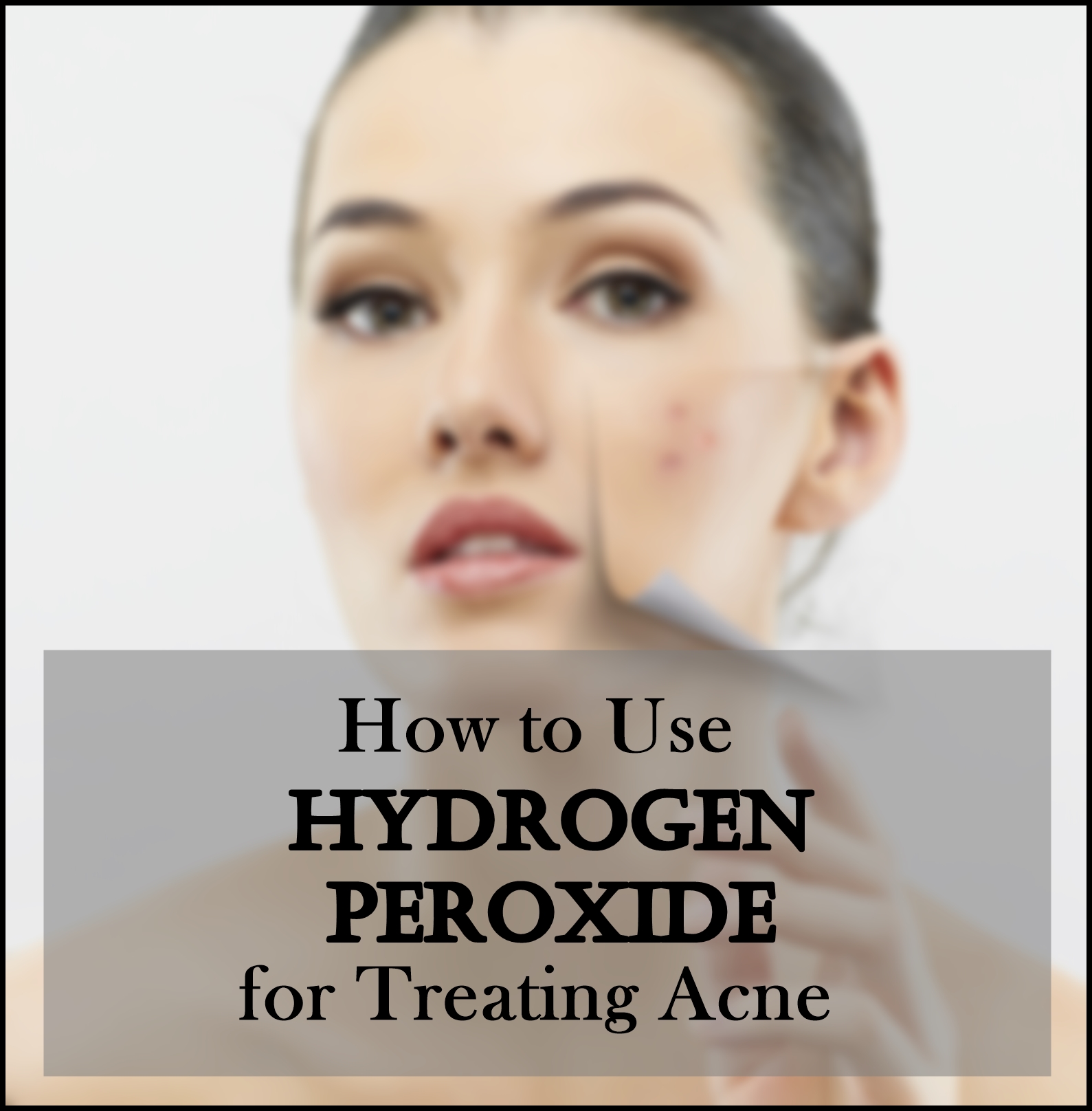 How to Use Hydrogen Peroxide for Treating AcneHow to Use Hydrogen Peroxide for Treating Acne